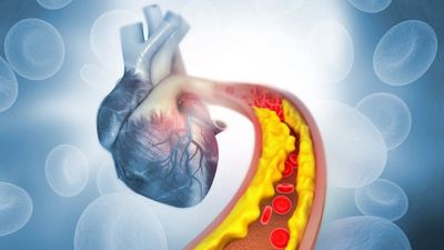 High Cholesterol: What You Need To Know - Sugar.Fit's photo