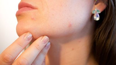 PCOS & Acne: Causes & Treatment - Sugar.Fit's photo