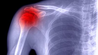 Frozen Shoulder & Diabetes - Causes, Symptoms & Treatment - Sugar.Fit's photo