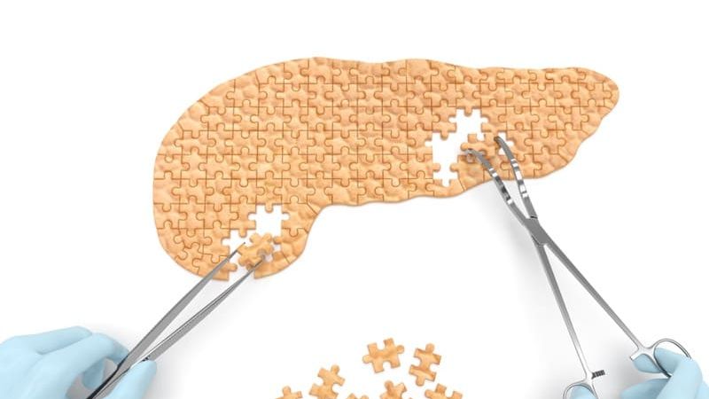 fibrocalculous pancreatic diabetes