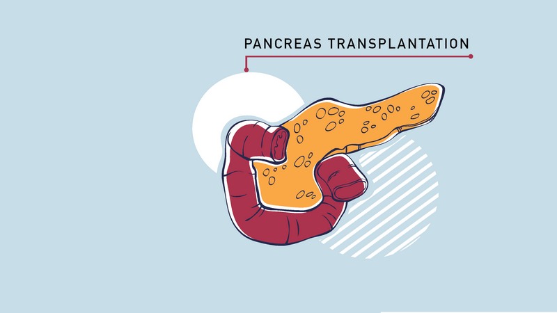 Pancreas Transplant Control Diabetes